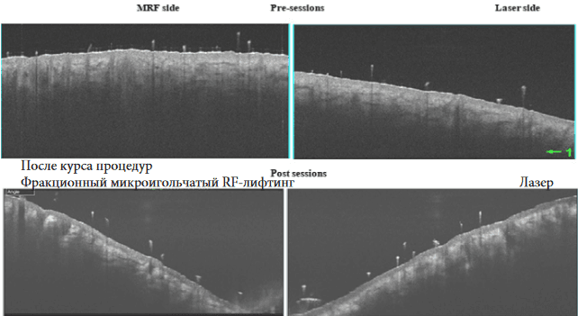 Изображение 2. Сторона, прошедшая многоигольчатый RF-лифтинг: толщина эпидермиса 77 μm, толщина дермы 381 μm до курса, увеличение толщины эпидермиса до 87 μm и дермы до 398 μm через 3 месяца. Сторона, прошедшая курс фракционного эрбиевого лазера: толщина эпидермиса 73 μm, толщина дермы 361 μm до курса; увеличение толщины эпидермиса до 81 μm и дермы до 380 μm через 3 месяца.