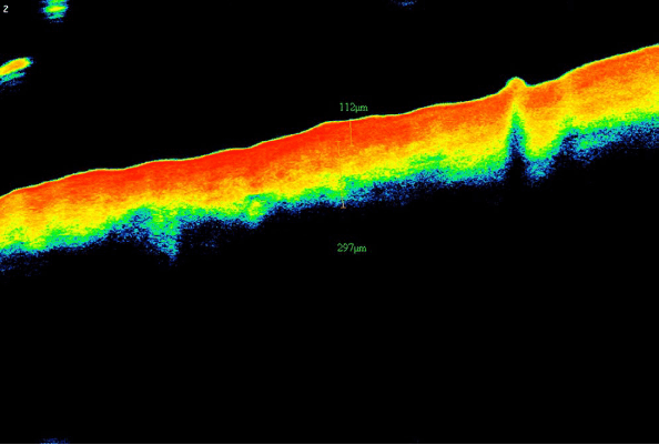 Изображение 6. Изображение ОКТ пациентки из группы Б, показывающее толщину дермы после курса процедур, равную 297 μm (оранжевая полоса от верхней границы желтого до нижней границы синего).