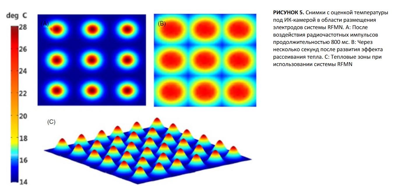 Рисунок 5. Снимки с оценкой температуры под ИК-камерой в области размещения электродов системы RFMN. A: После воздействия радиочастотных импульсов продолжительностью 800 мс. B: Через несколько секунд после развития эффекта рассеивания тепла. C: Тепловые зоны при использовании системы RFMN.