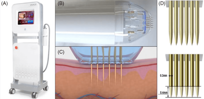 Рисунок 1. Устройство RFMN. А: Конструкция устройства. B: Наконечник с прикрепленным картриджем для микроигл, вид сбоку. C: Картридж с микроиглами с иглами, введенными в слой кожи. D: Неизолированные микроиглы (вверху) и изолированные микроиглы (внизу).