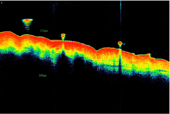 Изображение 2. Изображение ОКТ пациентки из группы А, демонстрирующее толщину дермы, равную 268 μm, после процедуры (оранжевая полоса от верхней границы желтого до нижней границы синего)