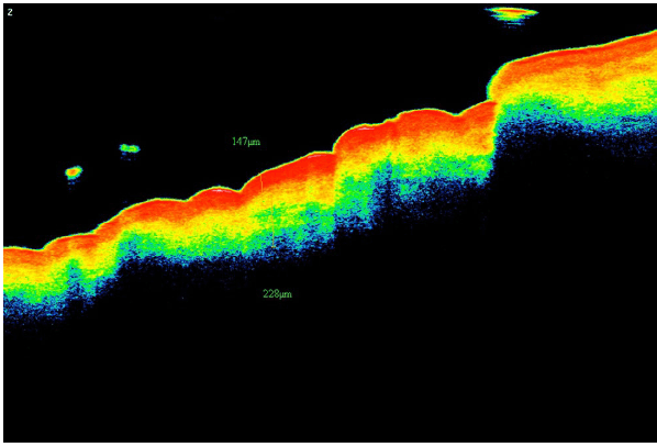 Изображение 1. Изображение ОКТ пациентки из группы А, демонстрирующее толщину дермы, равную 228 μm, до процедуры (оранжевая полоса от верхней границы желтого до нижней границы синего)