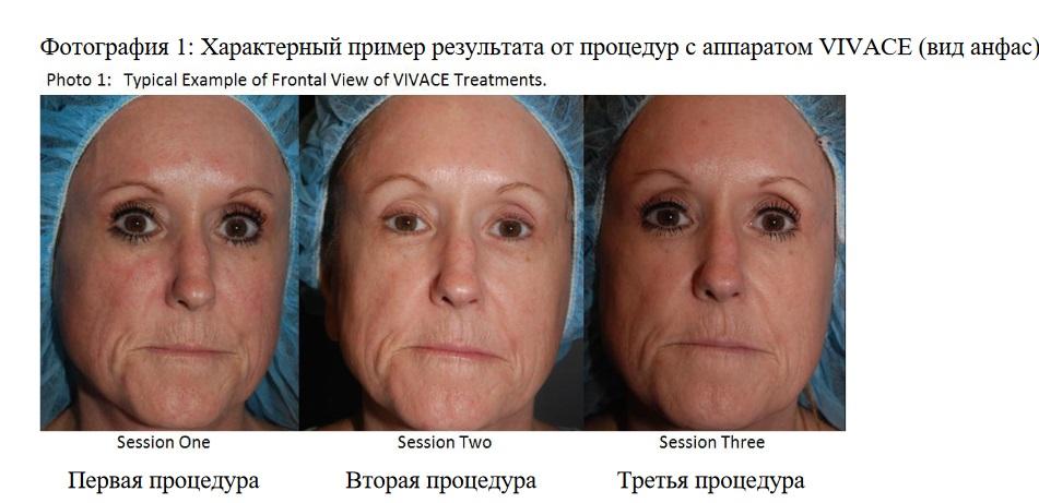 Фотография 1: Характерный пример результата от процедур с аппаратом VIVACE (вид анфас).