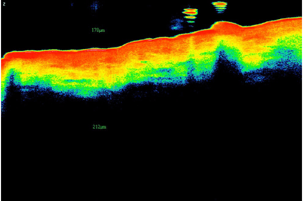 Изображение 5. Изображение ОКТ пациентки из группы Б, показывающее толщину дермы до курса процедур, равную 212 μm (оранжевая полоса от верхней границы желтого до нижней границы синего).