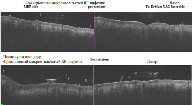 Изображение 4. Снимки ОКТ кейса 2. Сторона, прошедшая многоигольчатый RF- лифтинг: толщина эпидермиса 50 μm, толщина дермы 337 μm до курса; увеличение толщины эпидермиса до 52 μm и дермы до 345 μm через 3 месяца. Сторона, прошедшая курс фракционного эрбиевого лазера: толщина эпидермиса 50 μm, толщина дермы 333 μm до курса; увеличение толщины и эпидермиса до 54 μm, и дермы до 336 μm через 3 месяца.