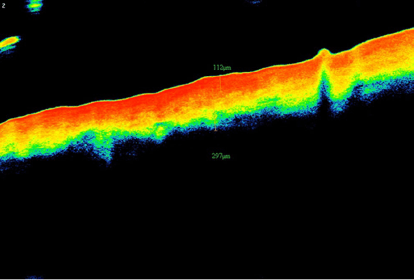 Изображение 6 Изображение ОКТ пациентки из группы Б, показывающее толщину дермы после курса процедур, равную 297 μm (оранжевая полоса от верхней границы желтого до нижней границы синего)