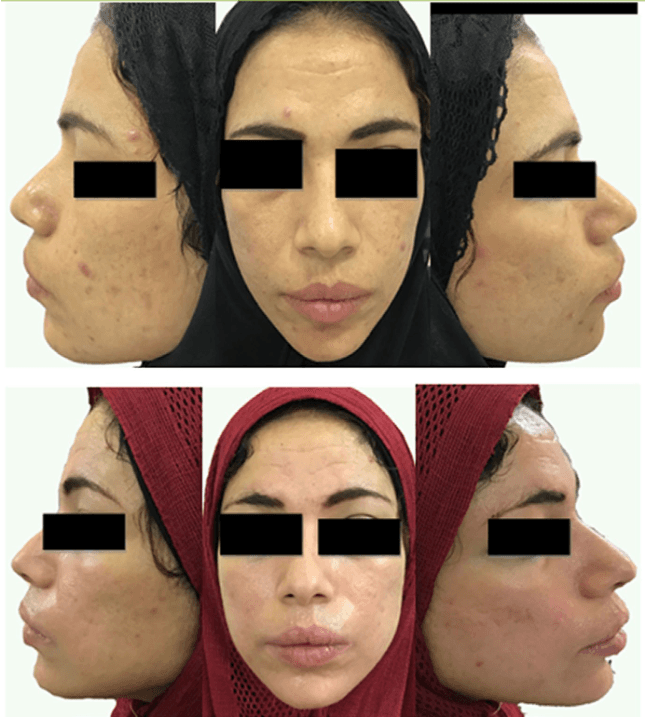 Изображение 3 Анфас, правая и левая сторона лица 30-летней женщины (кейс 2). До процедуры – верхний ряд изображений, и 3 месяца спустя курса процедур – нижний ряд, демонстрирующий существенные клинические улучшения состояния рубцов постакне.