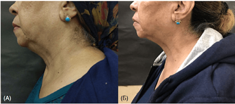 Изображение 3 Вид пациентки из группы А сбоку (фракционный микроигольчатый RF-лифтинг +плазмолифтинг) (А) до процедуры, (Б) после 3 процедур