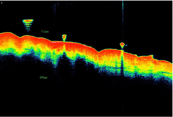 Изображение 2 Изображение ОКТ пациентки из группы А, демонстрирующее толщину дермы, равную 268 μm, после процедуры (оранжевая полоса от верхней границы желтого до нижней границы синего)