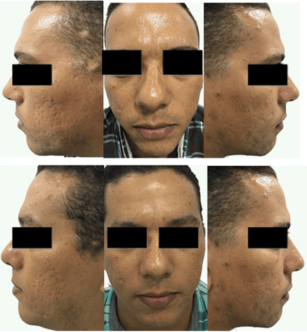 Изображение 5 нфас, правая и левая сторона лица 38-летнего мужчины (кейс 3). До процедуры – верхний ряд изображений, и 3 месяца спустя курса процедур – нижний ряд, демонстрирующий существенные клинические улучшения состояния рубцов постакне.